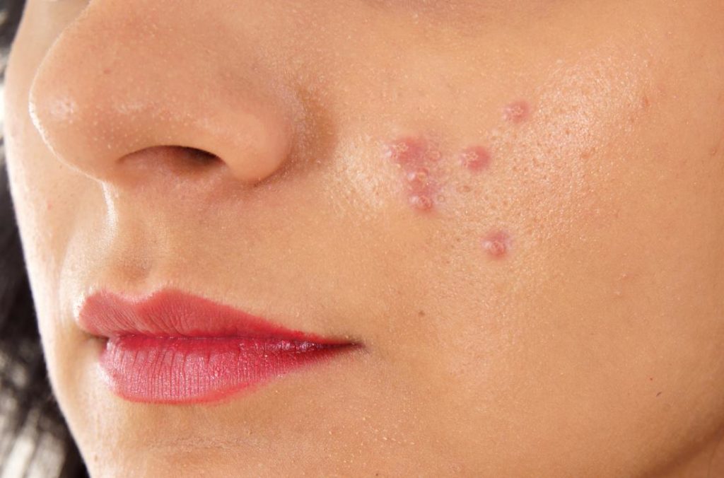 Acne around mouth