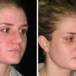 skin purging