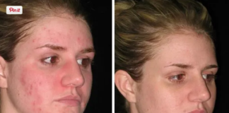 skin purging