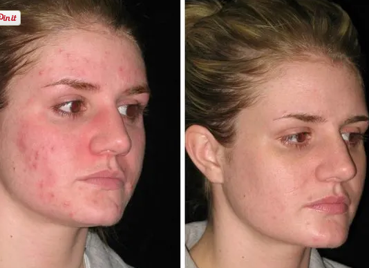 skin purging