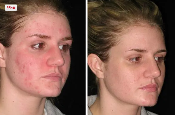 Isolaz used for cystic shrink pimple