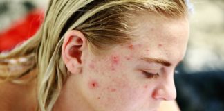 do acne scars go away