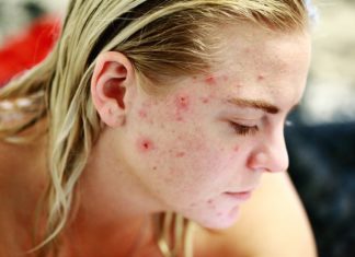 do acne scars go away