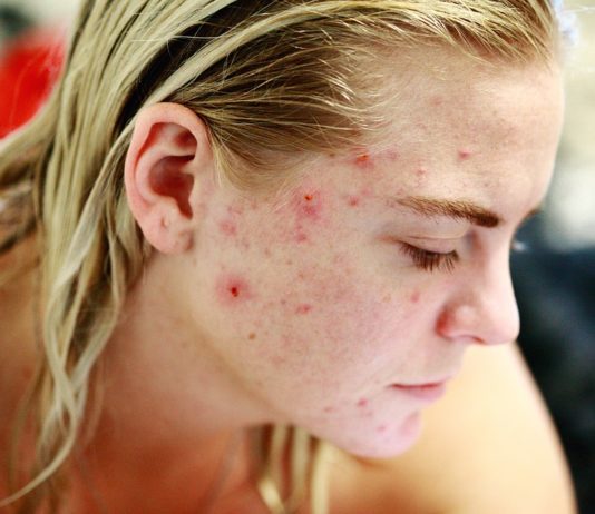 do acne scars go away