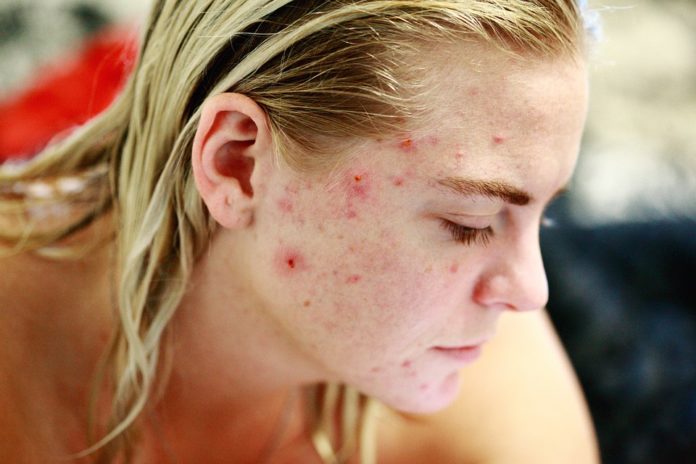 do acne scars go away