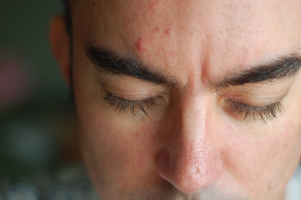Hormonal Acne in Male
