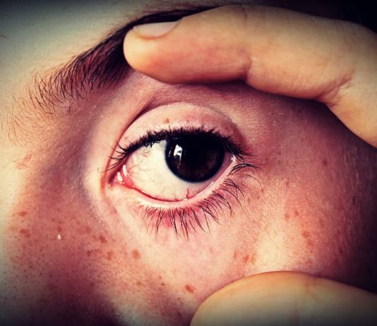 red spot on skin under eye