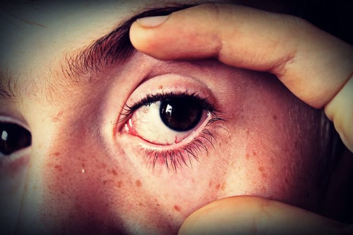 red spot on skin under eye