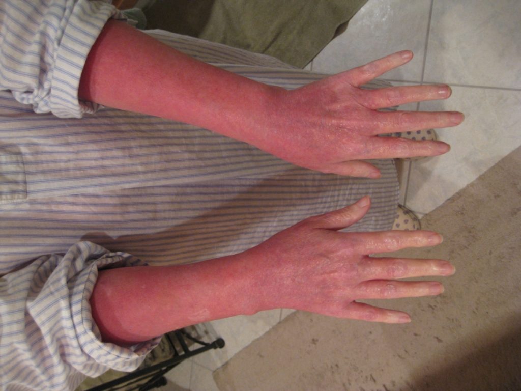  Red Skin Syndrome