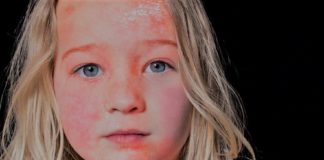 Red Skin Syndrome