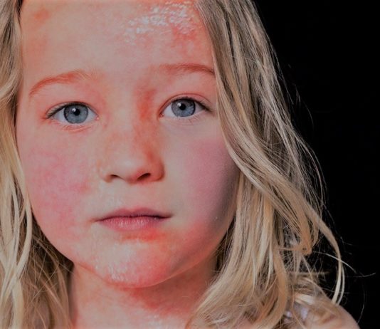 Red Skin Syndrome