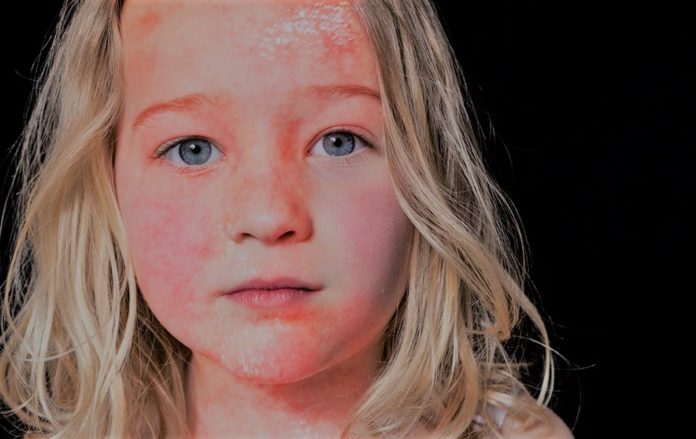 Red Skin Syndrome