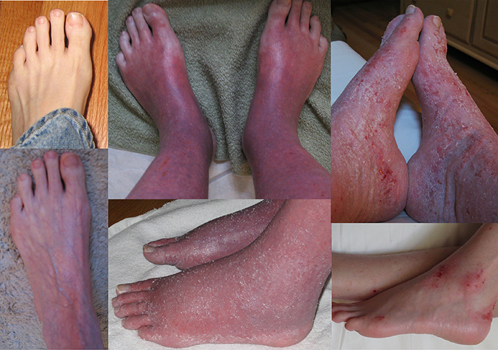 red skin syndrome 
