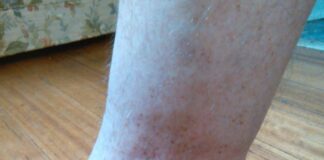 brown spots on ankles
