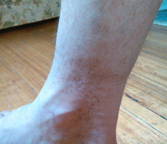brown spots on ankles