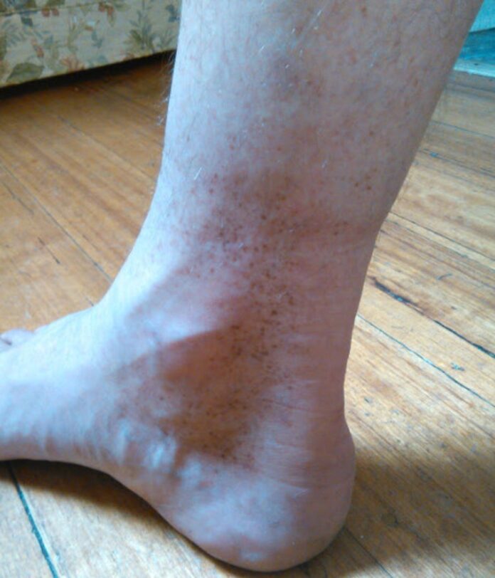 brown spots on ankles