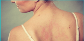 tanning bed rash
