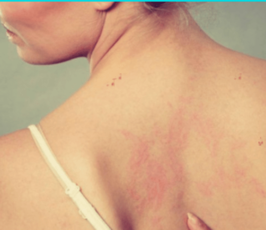 tanning bed rash