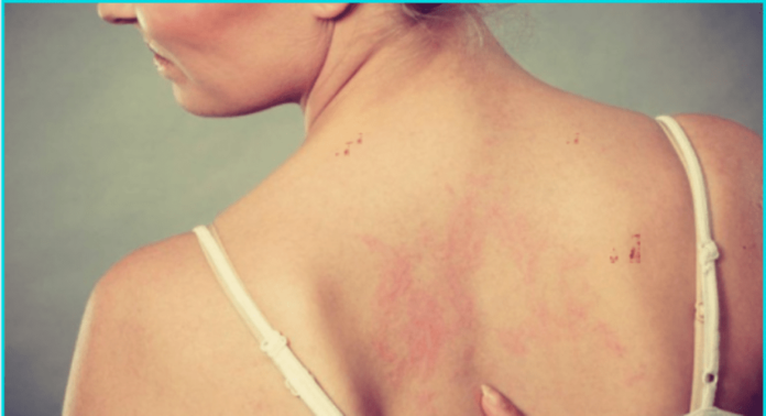 tanning bed rash