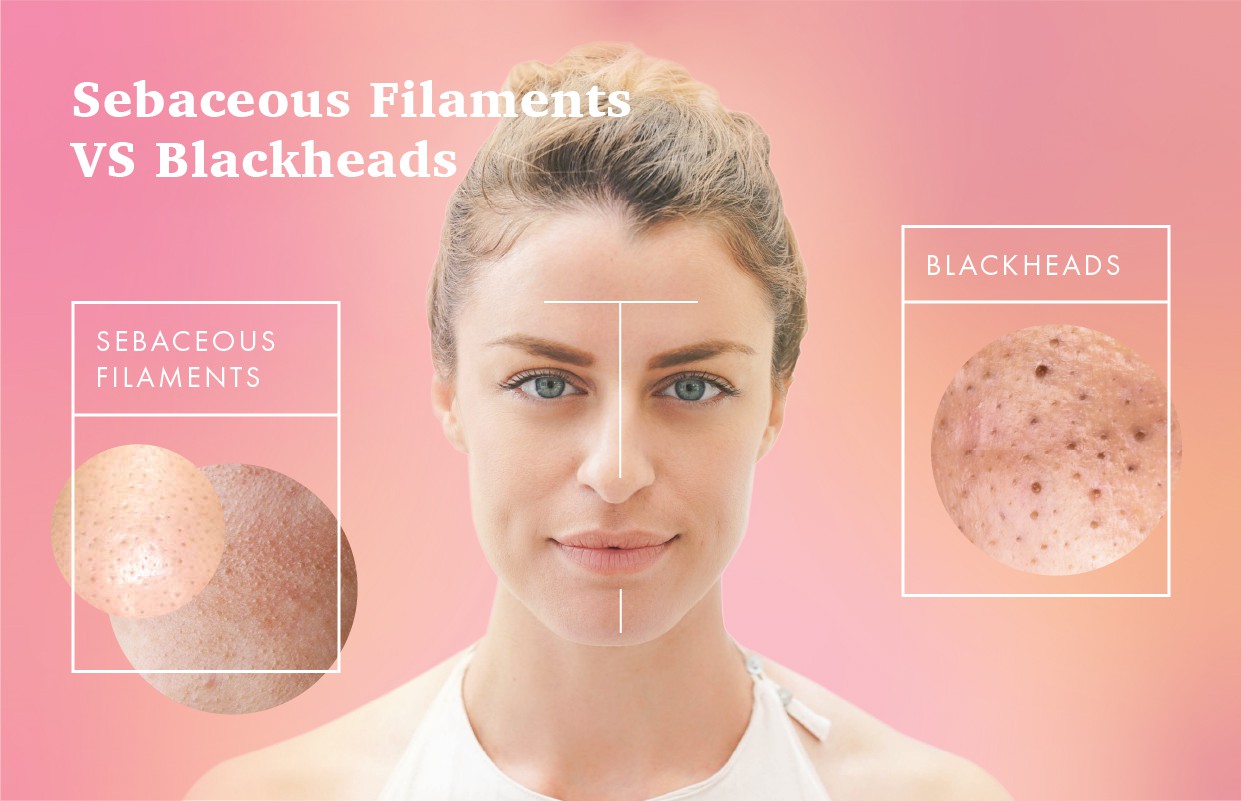 Sebaceous filaments nose