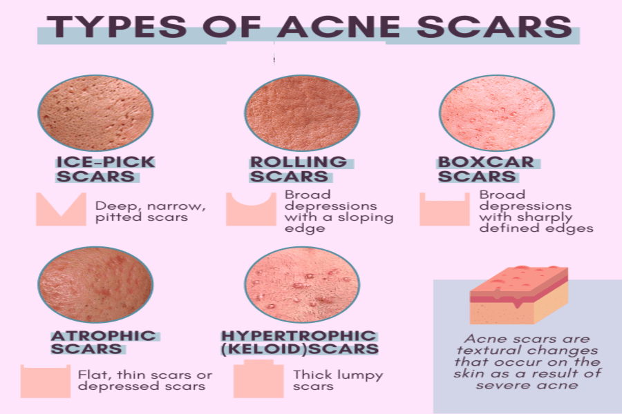 Types of Acne Scars